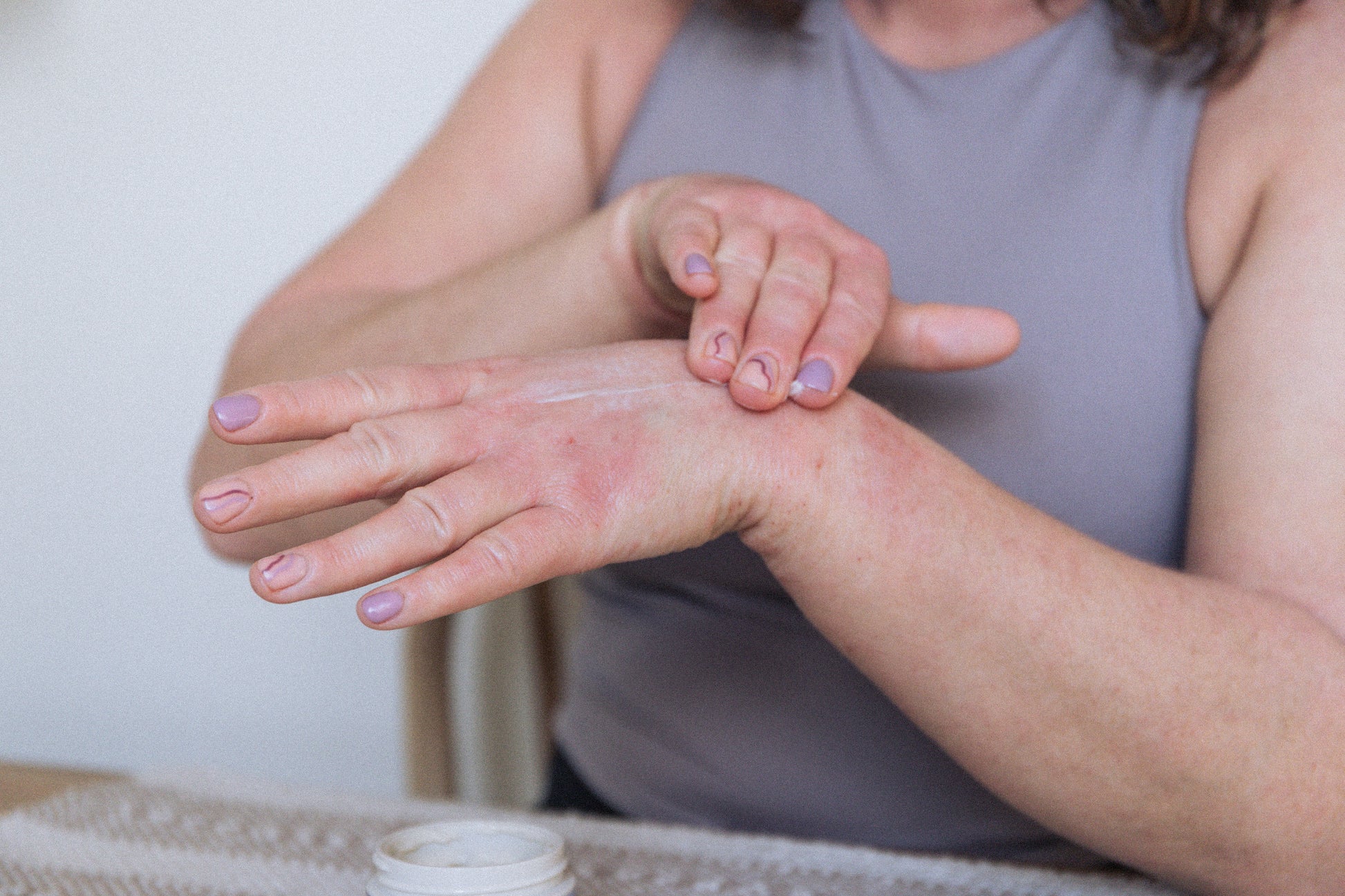 Person with eczema psoriasis applying cream to their hand with a neutral background